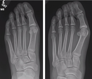 Special Considerations for Hallux Valgus in the Military Population