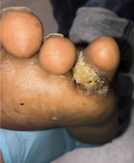 When Pedal Verruca Vulgaris is Actually Verrucous Carcinoma