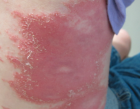 psoriasis generalized pustular