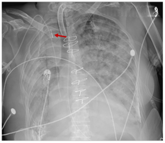 Araj Balloon Pump Figure 3