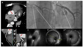 Barrios Pulmonary Hypertension Figure 1