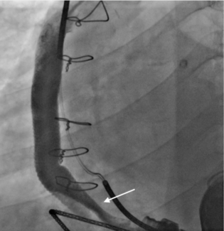 Dogan Angiography Figure 1
