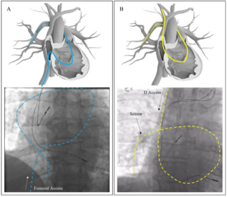 Guichard Pulmonary Artery Figure 5