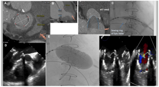 Gupta Ventricular Embolization Figure 1