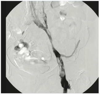 Lichtenberg Aspirex TN