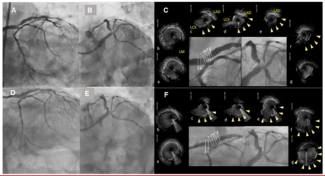 Murasato Quadrifurcation Lesion Figure 1