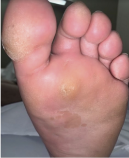 Shortening of the First Ray With Hallux Valgus Correction