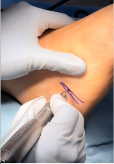 Minimally Invasive Surgery as an Evolving Approach to Limb Salvage