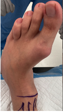 Pertinent Surgical Pearls on Management of Skew Foot Deformity in the Young Adult