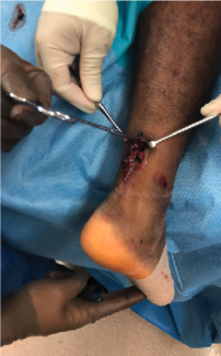 The Achilles Tendon—an A to Z Review of Treatment Options