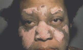 systemic lupus erythematosus