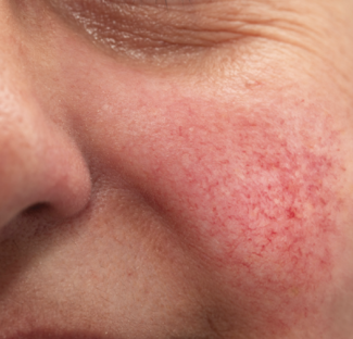 rosacea