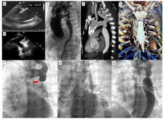 Vijayvergiya Coarctation of Aorta Figure 1