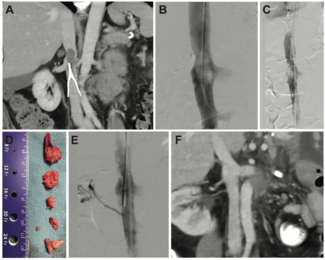 Amin IVC Filter Figure 1