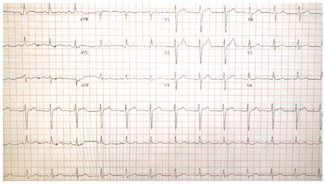 Dokollari Coronary Spasm Figure 1