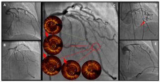 Gagno Coronary Perforation Figure 1