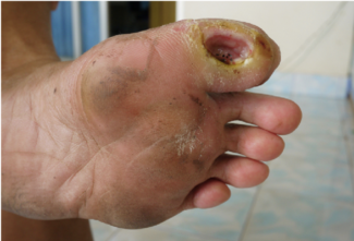 The Biomechanical Effects of Diabetic Neuropathy