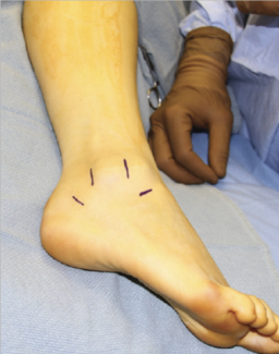 Does Lateral Ankle Stabilization Need to Be Augmented?