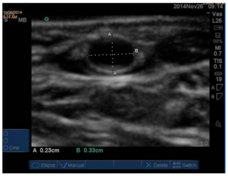 Roberts Transradial Access Figure 1