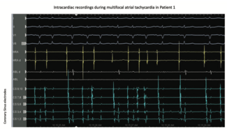 Sridhar Tachycardia Figure 2