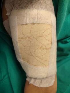 Figure 2. Appliance of ibuprofen-containing foam dressing