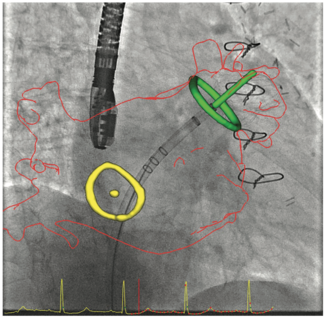 Kimmelstiel Structural Heart Interventions Figure 3