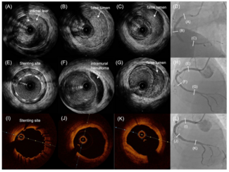 Ozaki Artery Dissection Figure 1
