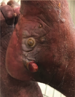 Exophytic Lesions in a 102-Year-Old Patient