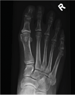 Considering the Power of Pediatric Flexible Flatfoot Procedures