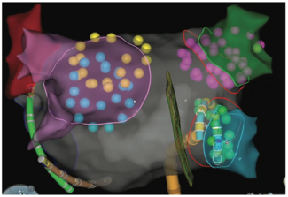 Patel Pulsed Field Ablation Figure 3