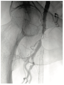 Scott Femoral Bifurcation Figure 1