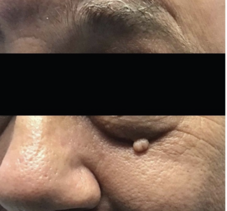 Figure 1. Flesh-colored, smooth, dome-shaped papule located on the left lower eyelid.