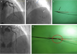 Theodoropoulos Stent Damage Associated With a GCE