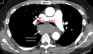 Alexandre Coil Embolization Figure 2