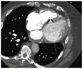 Kovacs Nonischemic Cardiomyopathy Figure 1