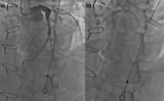 Kutkut Presnaring Technique Figure 3