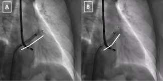 Muiños Amplatzer Figure 3