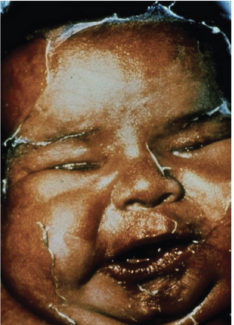 Staphylococcal scalded skin syndrome