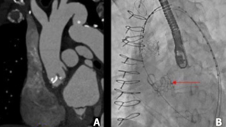Stathogiannis TAVR Figure 1