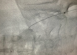 Tai “Tip In” Technique Figure 2