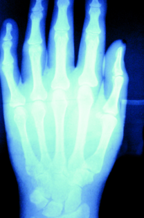 hand xray