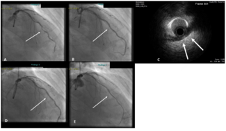 Abdalwahab Myocardial Muscle Bridges Figure 1