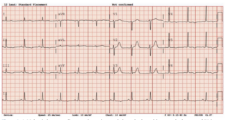 Alzayer Acute Coronary Syndrome Figure 1