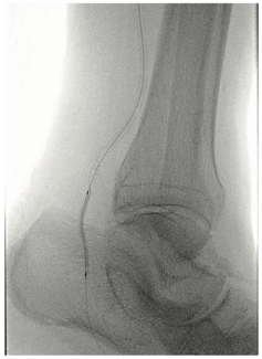 Meisner Serranator PTA Figure 3