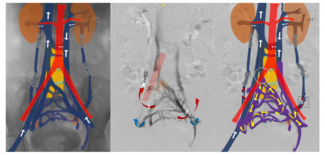 Figure 3.  Illustrative diagrams overlaid on unsubtracted digital subtraction angiography (DSA) and DSA images (venogram obtained after selective left internal iliac vein cannulation) showing flow hemodynamic after ovarian vein embolization (OVE) in May-Thurner syndrome-induced pelvic congestion syndrome. 