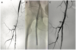Prasad Bilateral Femoropopliteal Figure 1