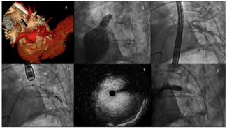 Rivero Occluded Pulmonary Figure 1