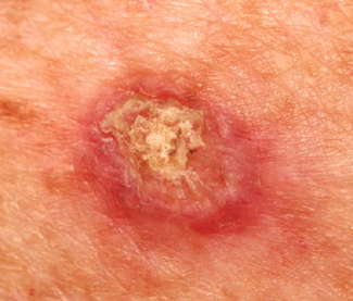 squamous cell carcinoma