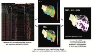 Dhanjal Ventricular Tachycardia Figure 4