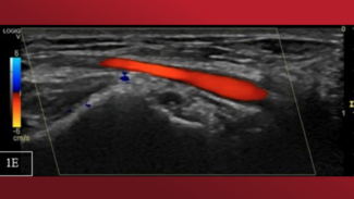 Karelas Avulsed Fragment Figure 1E